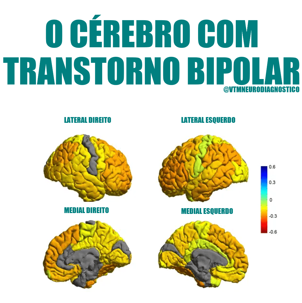 O Cérebro com Transtorno Bipolar - VTM NEURODIAGNÓSTICO